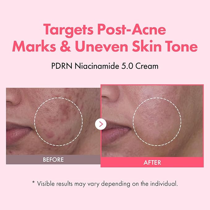 TOSOWOONG PDRN Niacinamide 5.0 Cream, Niacinamide 5% Dark Spot Remover for Face, Hyperpigmentation & Blemish Care, Salmon DNA Hydrating Moisturizer, Korean Skincare, 50ml / 1.69 fl. oz.