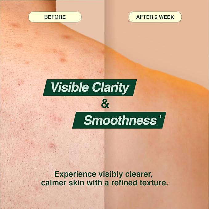 Tea Tree 90 Clear Body Mist for acne skin | 360° Moisture Spraying with Vegan Formula | AHA+BHA+PHA+LHA, Korean Skincare (6.76 fl oz, 200ml)