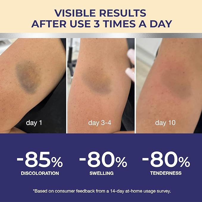 Arnica Bruise Cream Extra Strength: Fast Healing Arnica Cream for Bruising Swelling Thin Skin-Enhanced Recovery Vitamin K Creams With Arnica Montana, VK, C&E– Soothing Hydrating for senior, Adult, Kid