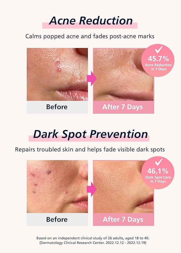 Easyderm Real Calming Patch – 6 Spot Patches, K-Beauty Skincare with Niacinamide, Hyaluronic Acid, EGF Micro Point length : 285μm