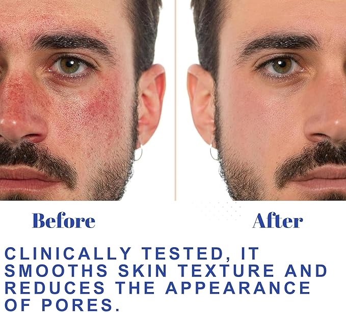 Witch Hazel Toner, Hydrating, Refreshing Face Mist, Rose Water with Salicylic, & Glycolic Acid, Zero Pore Cleanser, Removes Makeup, Dirt, Oil, Fades Dark Spots & Minimizes Pores, Alcohol-Free, 100 ml