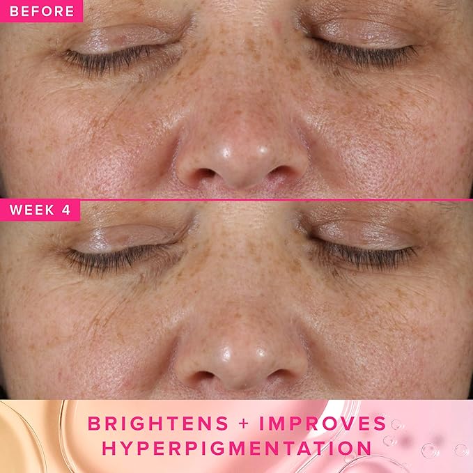 Farmacy 3% TXA Brightening Toner for Face - Dark Spot Corrector with Azelaic Acid, Tranexamic Acid + 5% PHA - Helps Even Texture + Tone, Fade Dark Spots + Exfoliate - Glow-Enhancing Skin Care (120ml)