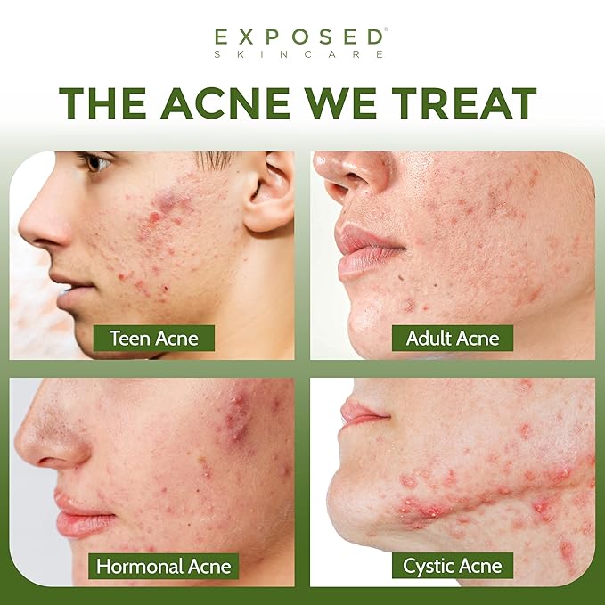 Exposed Skin Care, Moisture Complex Oil-Free Daily Face Moisturizer For Women and Men – Non-Comedogenic Lightweight Hydrating Gel with Green Tea, Pumpkin Seed and Caffeine for Oily, Acne-Prone Skin