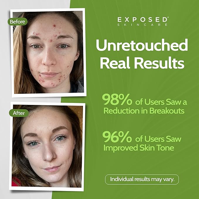 Exposed Skin Care, Moisture Complex Oil-Free Daily Face Moisturizer For Women and Men – Non-Comedogenic Lightweight Hydrating Gel with Green Tea, Pumpkin Seed and Caffeine for Oily, Acne-Prone Skin