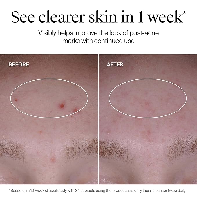 Neutrogena Evenly Clear Acne Cleanser with 2% Salicylic Acid & 2% PHA Exfoliant, Gentle Foaming Face Wash Clears Clogged Pores & Blackheads While Visibly Fading Look of Post-Acne Marks, 9.1 fl. oz